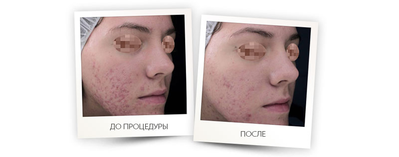 erglass1540_severe_acne.jpg