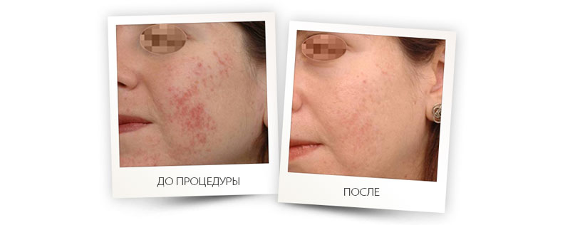 erglass1540_moderate_acne.jpg